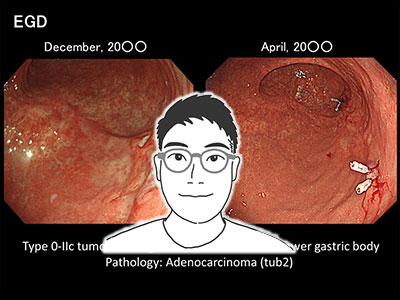 幽門側胃切除術（Distal gastrectomy）