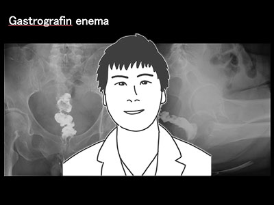 第5回　回腸人工肛門閉鎖術（Closure of the ileostomy）