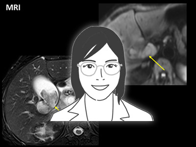 第7回　肝外胆管切除術（Resection of the extrahepatic bile duct）