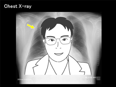 第8回　鼠径ヘルニア根治術（hernioplasty）