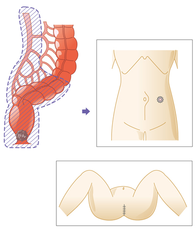 大腸の病気 日本消化器外科学会
