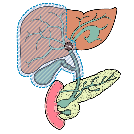 胆道の病気